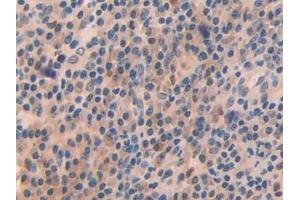 Detection of OIT3 in Human Skin cancer Tissue using Polyclonal Antibody to Oncoprotein Induced Transcript 3 (OIT3)