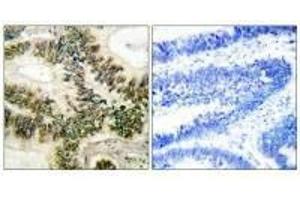 Immunohistochemical analysis of paraffin-embedded human colon carcinoma tissue using Cyclin E1 (Ab-395) antibody.