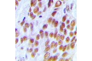 Immunohistochemical analysis of KDM1A staining in human breast cancer formalin fixed paraffin embedded tissue section. (LSD1 anticorps)