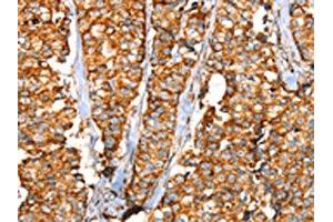 The image on the left is immunohistochemistry of paraffin-embedded Human breast cancer tissue using ABIN7192442(SLC25A3 Antibody) at dilution 1/35, on the right is treated with synthetic peptide.