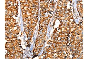 The image on the left is immunohistochemistry of paraffin-embedded Human breast cancer tissue using ABIN7192442(SLC25A3 Antibody) at dilution 1/35, on the right is treated with synthetic peptide. (SLC25A3 anticorps)