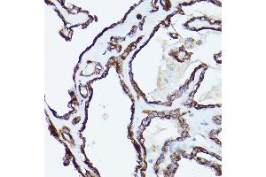 Immunohistochemistry of paraffin-embedded human thyroid cancer using Cytokeratin 19 (Cytokeratin 19 (KRT19)) Rabbit pAb (ABIN3020778, ABIN3020779, ABIN3020780 and ABIN6213719) at dilution of 1:150 (40x lens).