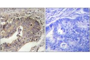 Immunohistochemistry analysis of paraffin-embedded human breast carcinoma tissue, using Fibrillin-1 Antibody. (Fibrillin 1 anticorps  (AA 2811-2860))