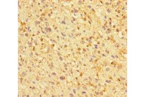 Immunohistochemistry of paraffin-embedded human glioma using ABIN7176271 at dilution of 1:100 (ZNF384 anticorps  (AA 1-245))