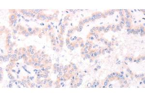Immunohistochemistry of paraffin-embedded Human thyroid cancer tissue using AMH Polyclonal Antibody at dilution 1:30 (AMH anticorps)