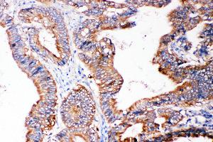 Anti-SMAD5 antibody, IHC(P) IHC(P): Human Intestinal Cancer Tissue
