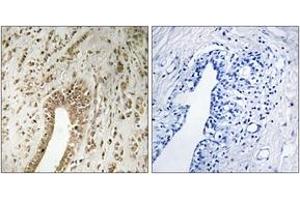 Immunohistochemistry analysis of paraffin-embedded human breast carcinoma tissue, using PHF3 Antibody. (PHF3 anticorps  (AA 1990-2039))