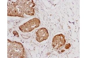 Expression of NTSR1 in human breast cancer - Immunohistochemical staining of human breast cancer cells using Anti-Neurotensin Receptor 1 (extracellular) Antibody (ABIN7043383, ABIN7044767 and ABIN7044768), (1:100).