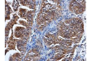 IHC-P Image HPRT antibody detects HPRT protein at cytoplasm in human endometrial cancer by immunohistochemical analysis. (HPRT1 anticorps)