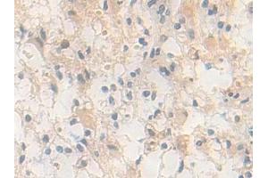 Detection of PDXK in Human Glioma Tissue using Polyclonal Antibody to Pyridoxal Kinase (PDXK)