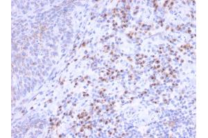 Formalin-fixed, paraffin-embedded human Unknown Tumor stained with RCAS1 Mouse Monoclonal Antibody (CPTC-EBAG9-1). (RCAS1 anticorps)