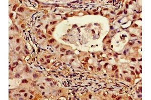 Immunohistochemistry of paraffin-embedded human lung cancer using ABIN7144848 at dilution of 1:100 (ATP5F1D anticorps  (AA 23-168))