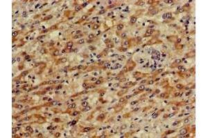 Immunohistochemistry of paraffin-embedded human liver cancer using ABIN7146606 at dilution of 1:100 (PRKACG anticorps  (Catalytic Subunit gamma))