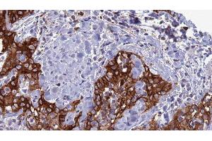 ABIN6277316 at 1/100 staining Human Head and neck cancer tissue by IHC-P. (CLEC4D anticorps  (Internal Region))