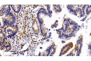 Detection of LIFR in Human Colorectal cancer Tissue using Polyclonal Antibody to Leukemia Inhibitory Factor Receptor (LIFR)
