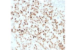 Formalin fixed paraffin embedded human colon carcinoma stained with p21 Rabbit Recombinant Monoclonal Antibody (CIP1/4377R).