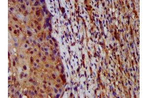 IHC image of ABIN7155245 diluted at 1:200 and staining in paraffin-embedded human lung cancer performed on a Leica BondTM system. (HAL anticorps  (AA 36-152))