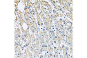 Immunohistochemistry of paraffin-embedded human liver injury using UQCRC2 antibody at dilution of 1:100 (x40 lens). (UQCRC2 anticorps)