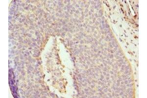 Immunohistochemistry of paraffin-embedded human cervical cancer using ABIN7150033 at dilution of 1:100 (DAAM2 anticorps  (AA 1-86))