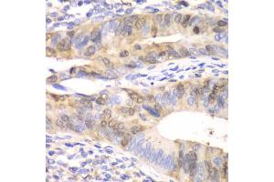 Immunohistochemistry of paraffin-embedded human colon carcinoma using UBE2C antibody (ABIN5973207) at dilution of 1/100 (40x lens). (UBE2C anticorps)