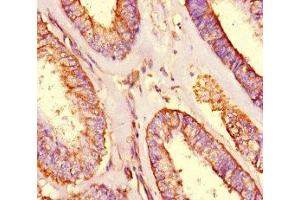 Immunohistochemistry of paraffin-embedded human endometrial cancer using ABIN7166128 at dilution of 1:100 (SHROOM3 anticorps  (AA 1309-1571))