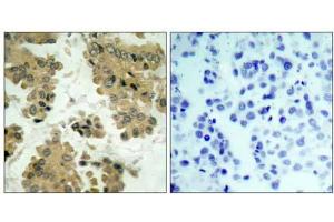 Immunohistochemical analysis of paraffin-embedded human lung carcinoma tissue using Akt2 (Ab-474) antibody (E021155). (AKT2 anticorps)