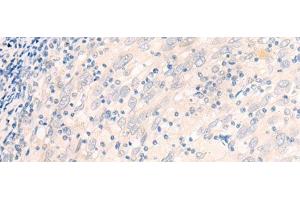 Immunohistochemistry of paraffin-embedded Human cervical cancer tissue using EME2 Polyclonal Antibody at dilution of 1:40(x200) (EME2 anticorps)