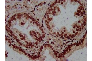 IHC image of ABIN7168396 diluted at 1:500 and staining in paraffin-embedded human prostate cancer performed on a Leica BondTM system.