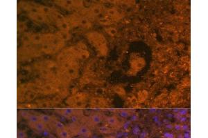 Immunofluorescence analysis of Human liver cancer using AFP Monoclonal Antibody at dilution of 1:100.