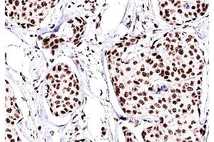 ABIN6269094 at 1/200 staining human Breast cancer tissue sections by IHC-P.