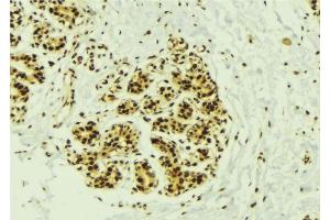 ABIN6277540 at 1/100 staining Human breast cancer tissue by IHC-P. (NEK2 anticorps  (Internal Region))