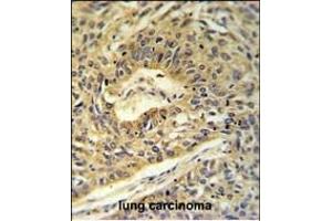ATP5A1 Antibody (C-term) (ABIN653734 and ABIN2843039) IHC analysis in formalin fixed and paraffin embedded lung carcinoma followed by peroxidase conjugation of the secondary antibody and DAB staining.