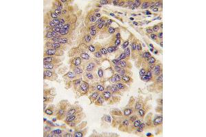 Formalin-fixed and paraffin-embedded human lung carcinoma tissue reacted with GJA5 antibody (N-term), which was peroxidase-conjugated to the secondary antibody, followed by DAB staining.