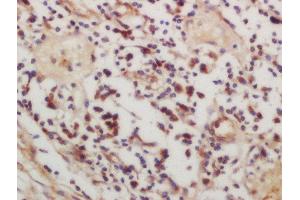 Formalin-fixed and paraffin embedded human lung carcinoma labeled with Rabbit Anti-CSK (Ser364) Polyclonal Antibody, Unconjugated  at 1:200 followed by conjugation to the secondary antibody and DAB staining (CSK anticorps  (pSer364))