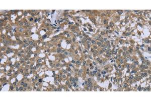 Immunohistochemistry of paraffin-embedded Human cervical cancer using PTK2B Polyclonal Antibody at dilution of 1:50