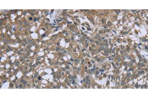 Immunohistochemistry of paraffin-embedded Human cervical cancer using PTK2B Polyclonal Antibody at dilution of 1:50