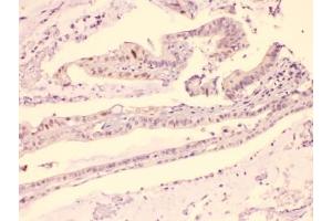 IHC testing of FFPE human intestinal carcinoma with HDGF antibody at 1ug/ml. (HDGF anticorps  (AA 61-97))