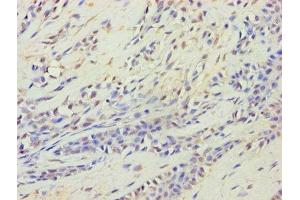 Immunohistochemistry of paraffin-embedded human breast cancer using ABIN7164537 at dilution of 1:100