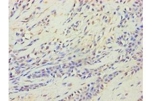 Immunohistochemistry of paraffin-embedded human breast cancer using ABIN7164537 at dilution of 1:100 (HARS2 anticorps  (AA 34-506))
