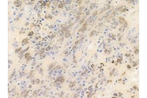 ABIN6255002 and ABIN6266460 at 1/100 staining human melanoma by IHC-P. (PAK3 anticorps  (pSer154))
