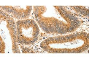 Immunohistochemistry of paraffin-embedded Human colon cancer using AKR1B1 Polyclonal Antibody at dilution of 1:30 (AKR1B1 anticorps)