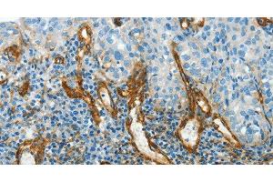 Immunohistochemistry of paraffin-embedded Human cervical cancer using CAV1 Polyclonal Antibody at dilution of 1:40 (Caveolin-1 anticorps)