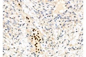 ABIN6264010 and ABIN6276948 at 1/100 staining Human ovarian cancer and adjacent normal tissues by IHC-P.