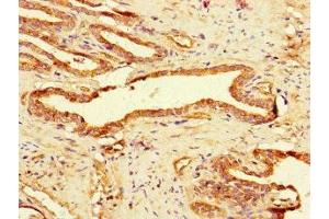 Immunohistochemistry of paraffin-embedded human prostate cancer using ABIN7158768 at dilution of 1:100 (GAA anticorps  (AA 601-952))