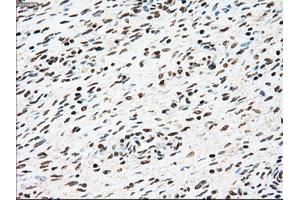 Immunohistochemical staining of paraffin-embedded Adenocarcinoma of colon tissue using anti-SSBmouse monoclonal antibody. (SSB anticorps)