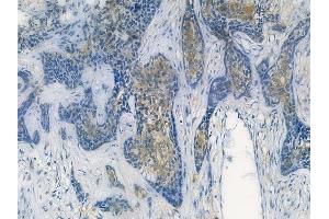 ABIN7093817 and ABIN7097860 at 1/100 staining human breast carcinoma by IHC-P. (CXCL2 anticorps  (C-Term))