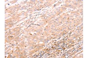 The image on the left is immunohistochemistry of paraffin-embedded Human esophagus cancer tissue using ABIN7189783(ALPPL2 Antibody) at dilution 1/20, on the right is treated with synthetic peptide.