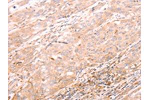 The image on the left is immunohistochemistry of paraffin-embedded Human esophagus cancer tissue using ABIN7189783(ALPPL2 Antibody) at dilution 1/20, on the right is treated with synthetic peptide. (ALPPL2 anticorps)