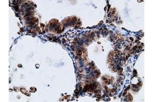 Immunohistochemical staining of paraffin-embedded Adenocarcinoma of Human breast tissue using anti-KHK mouse monoclonal antibody. (Ketohexokinase anticorps)