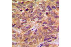 Immunohistochemical analysis of FOXO4 (pS197) staining in human breast cancer formalin fixed paraffin embedded tissue section.